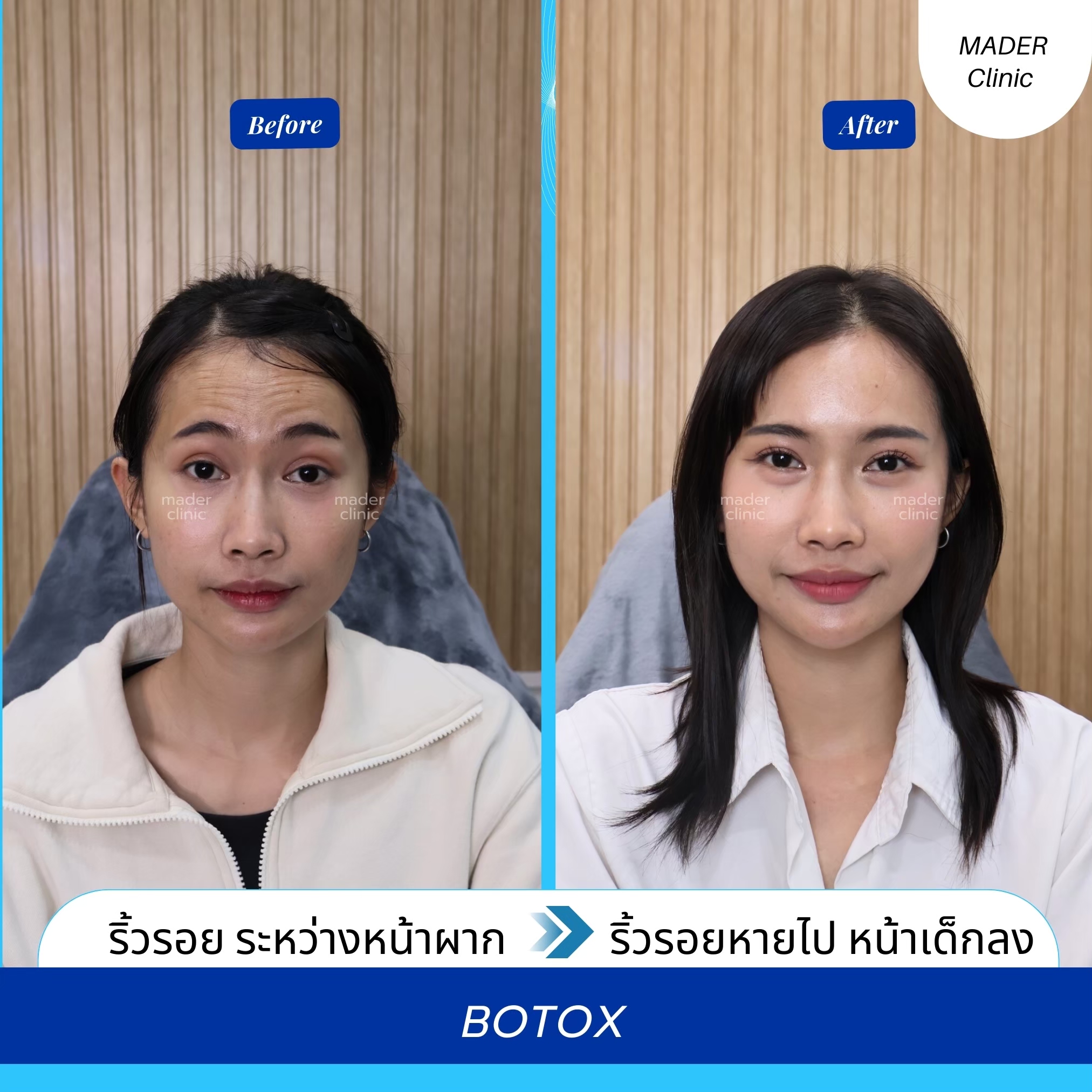 Botox HUTOX 50u