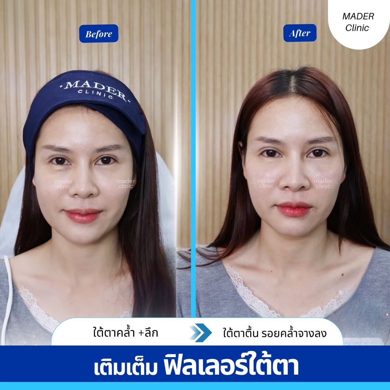 Filler ใต้ตา (Under Eye)