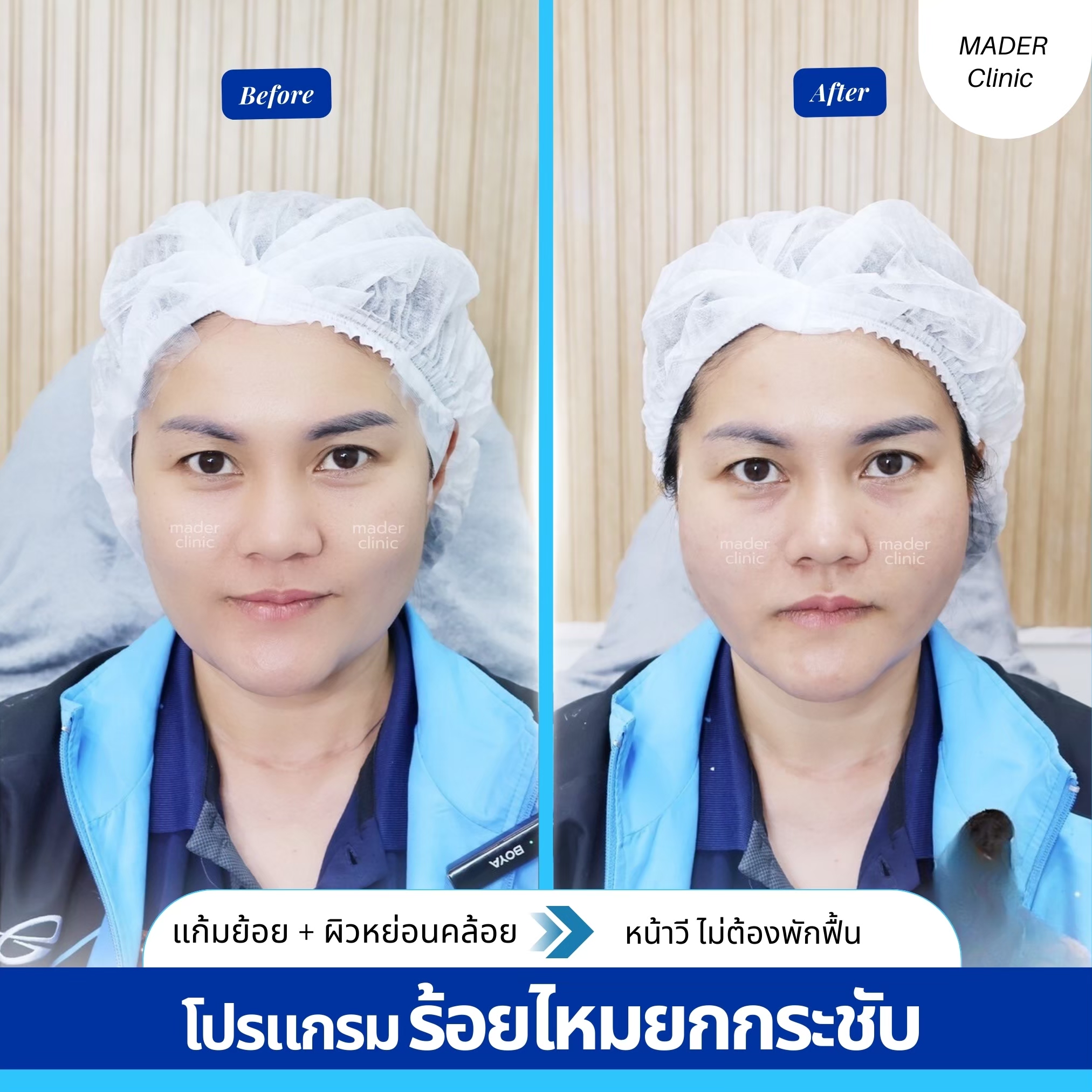ร้อยไหม 3 แถม 3