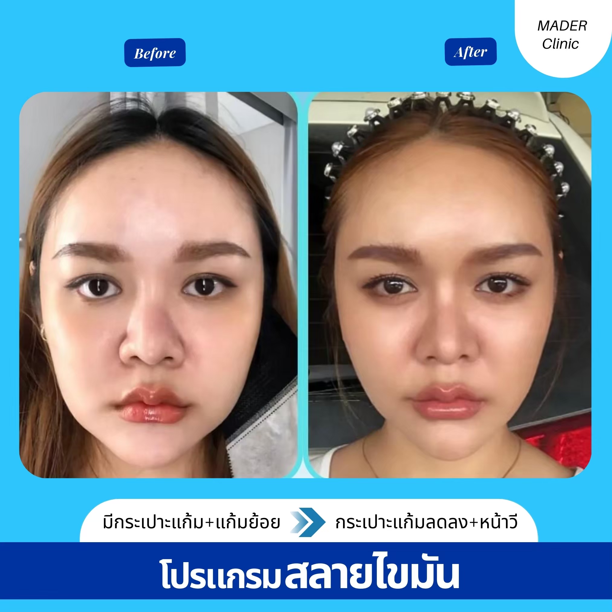 รีวิว MADER Clinic