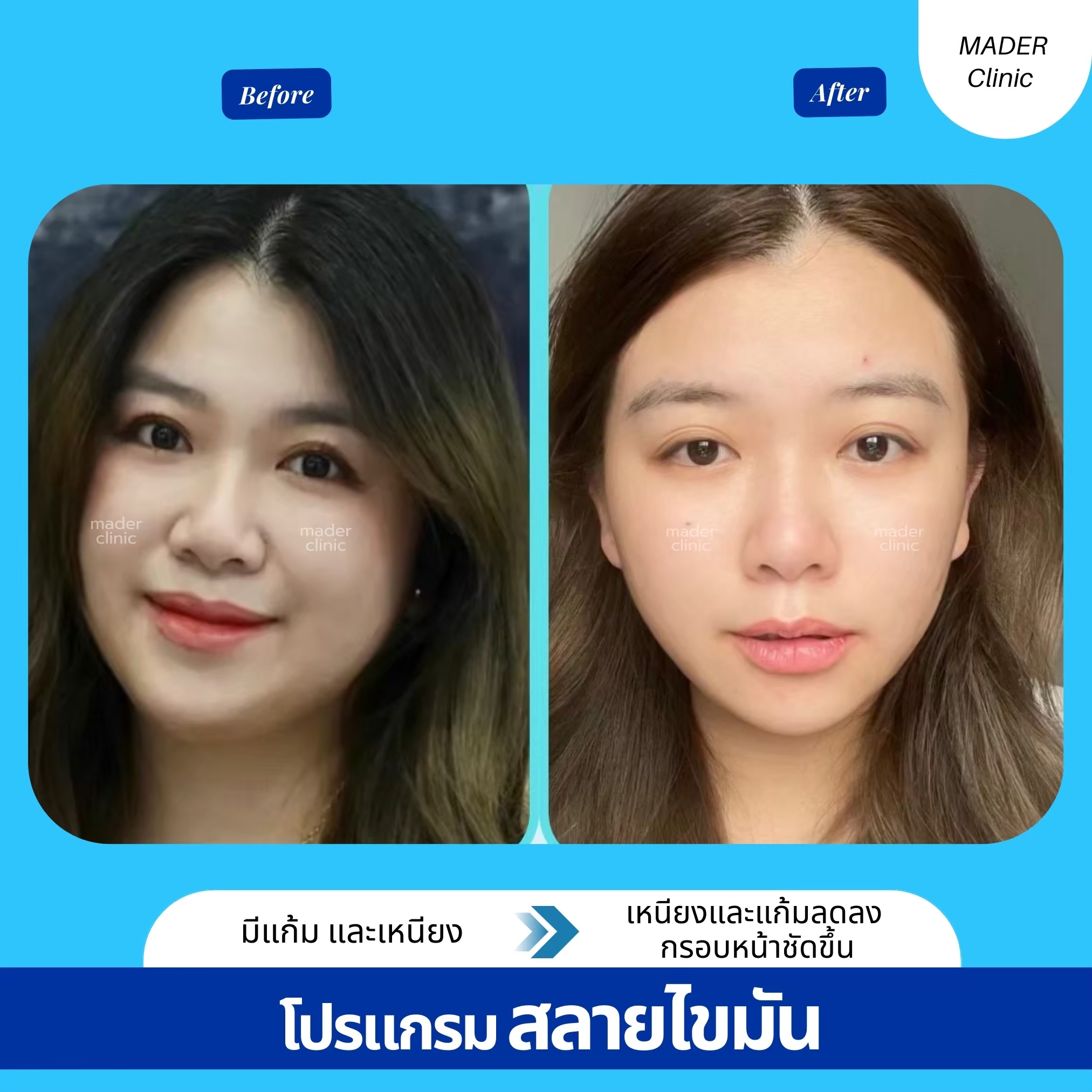 รีวิว MADER Clinic