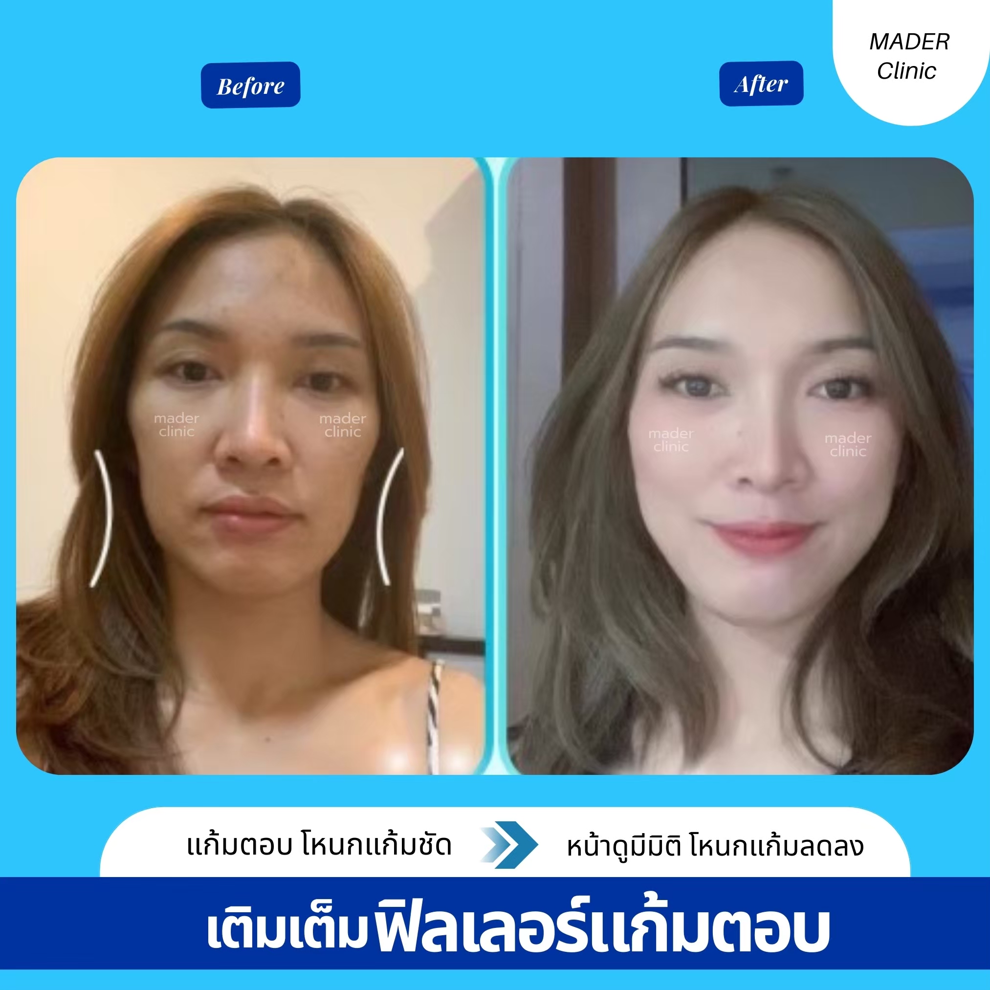 รีวิว MADER Clinic