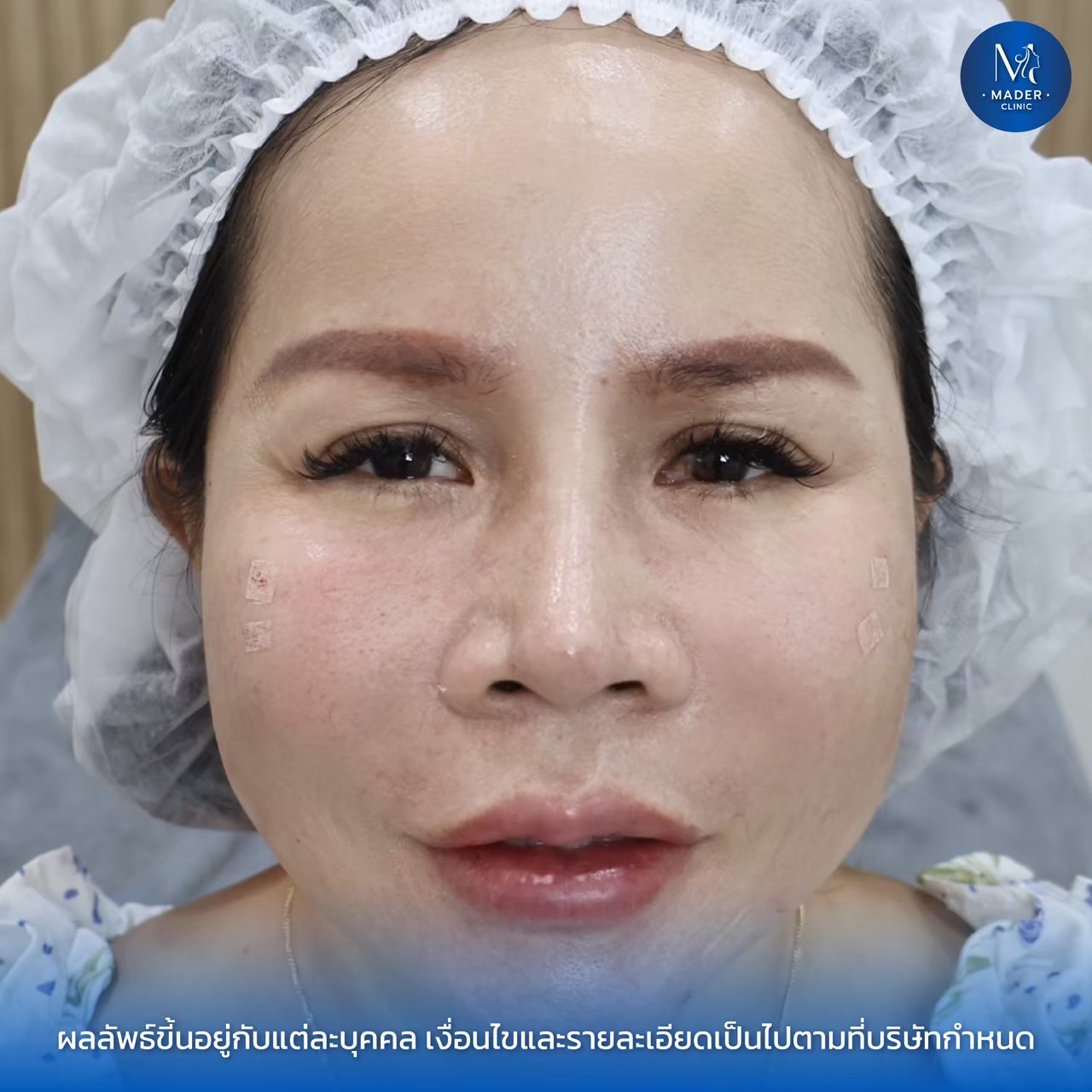 รีวิว MADER Clinic