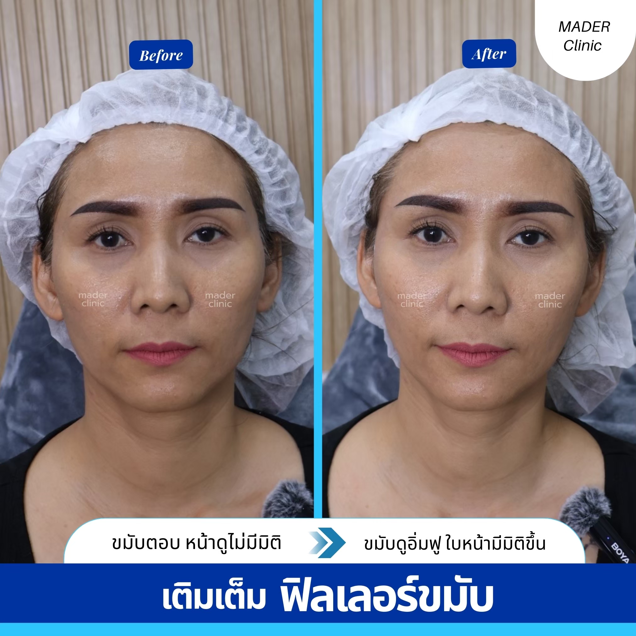 รีวิว MADER Clinic