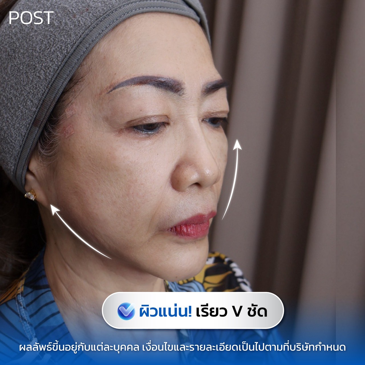 รีวิว MADER Clinic