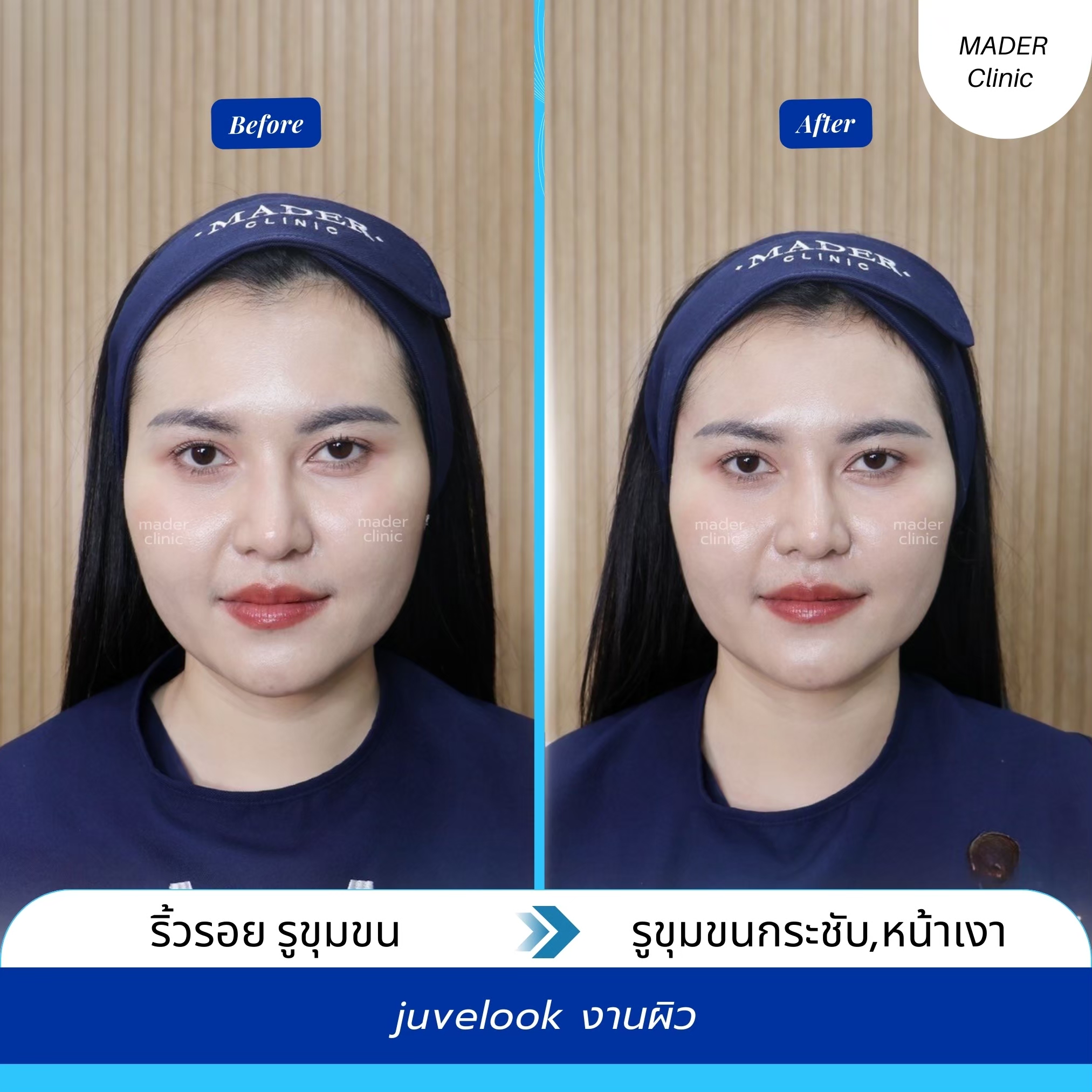 รีวิว MADER Clinic