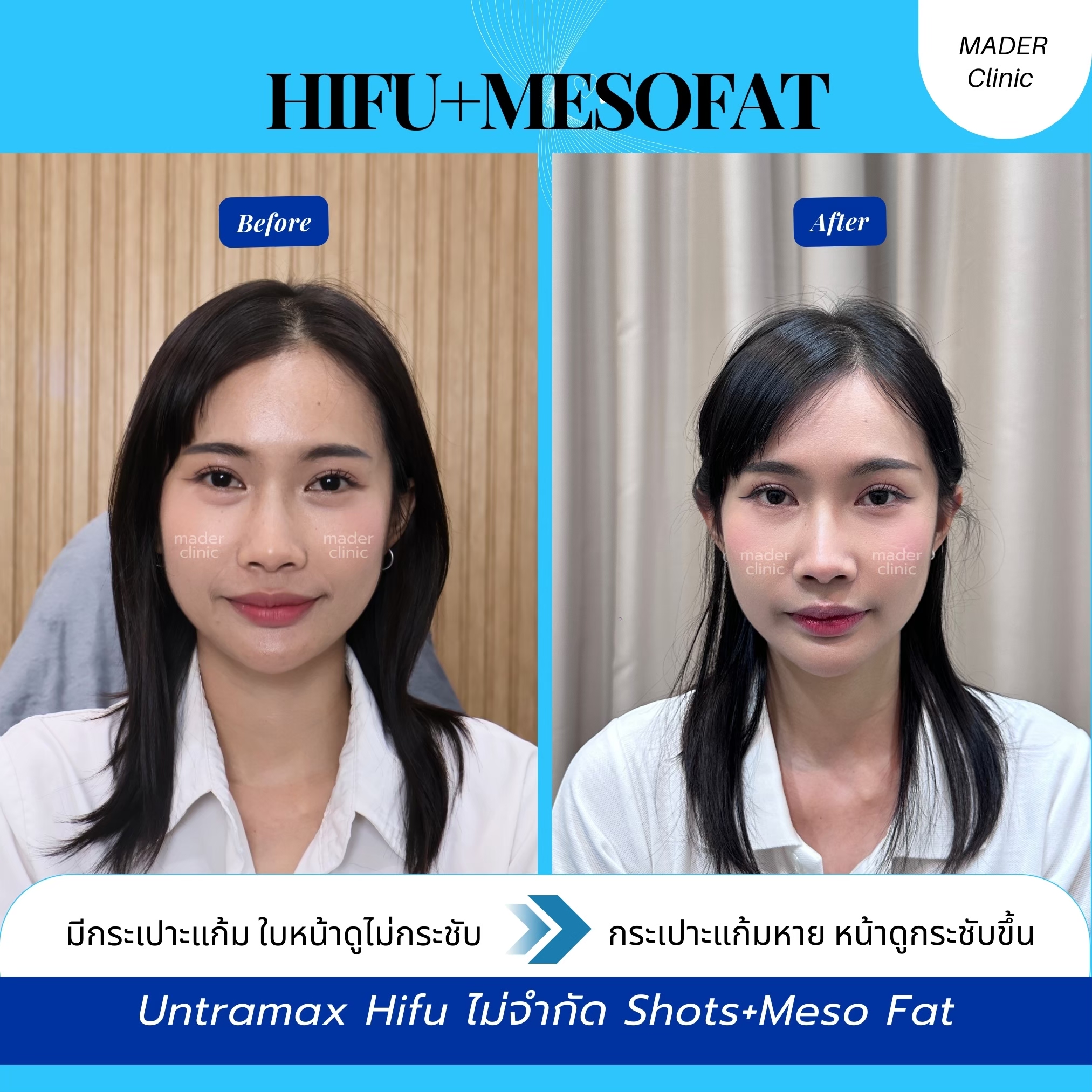 รีวิว MADER Clinic