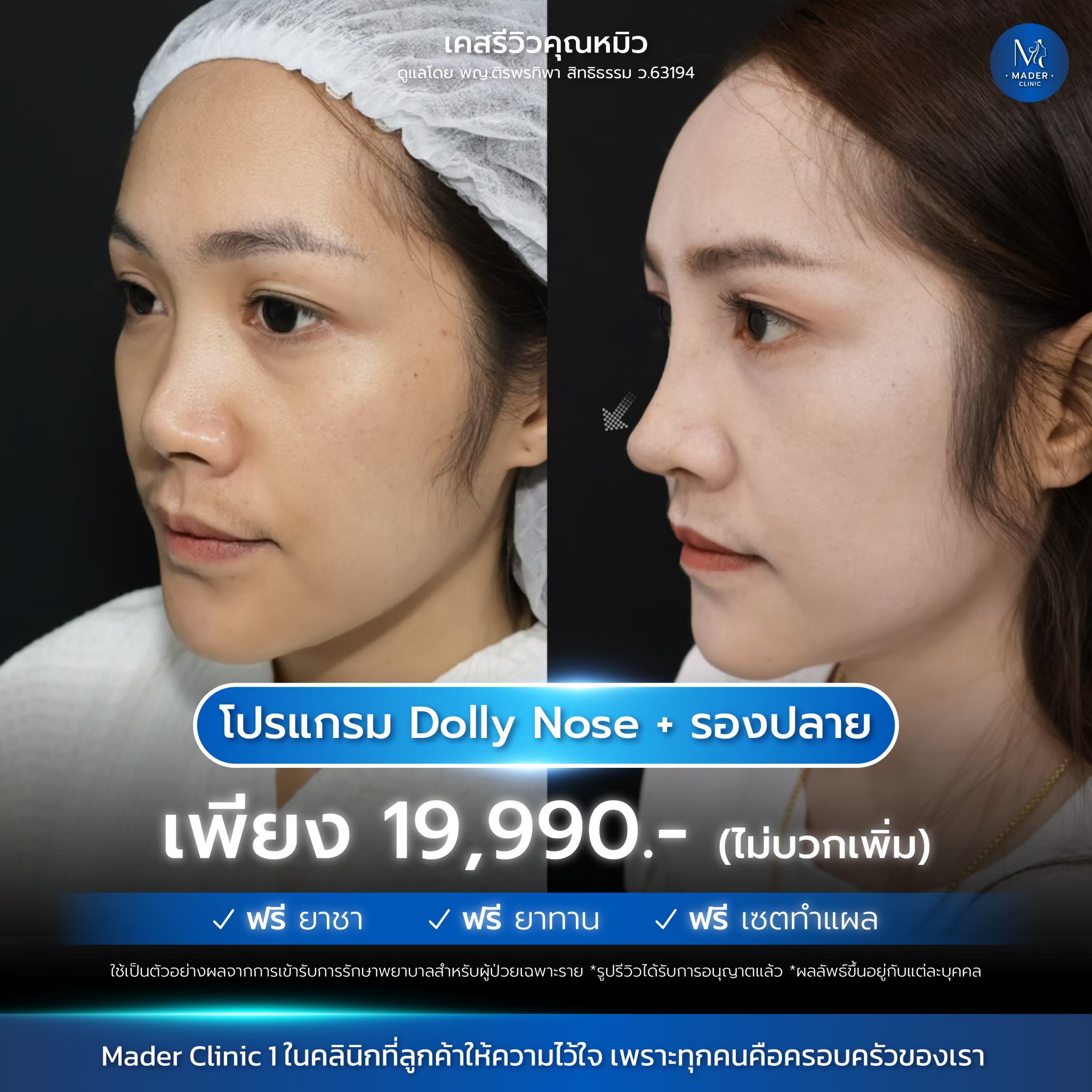 รีวิวเสริมจมูก