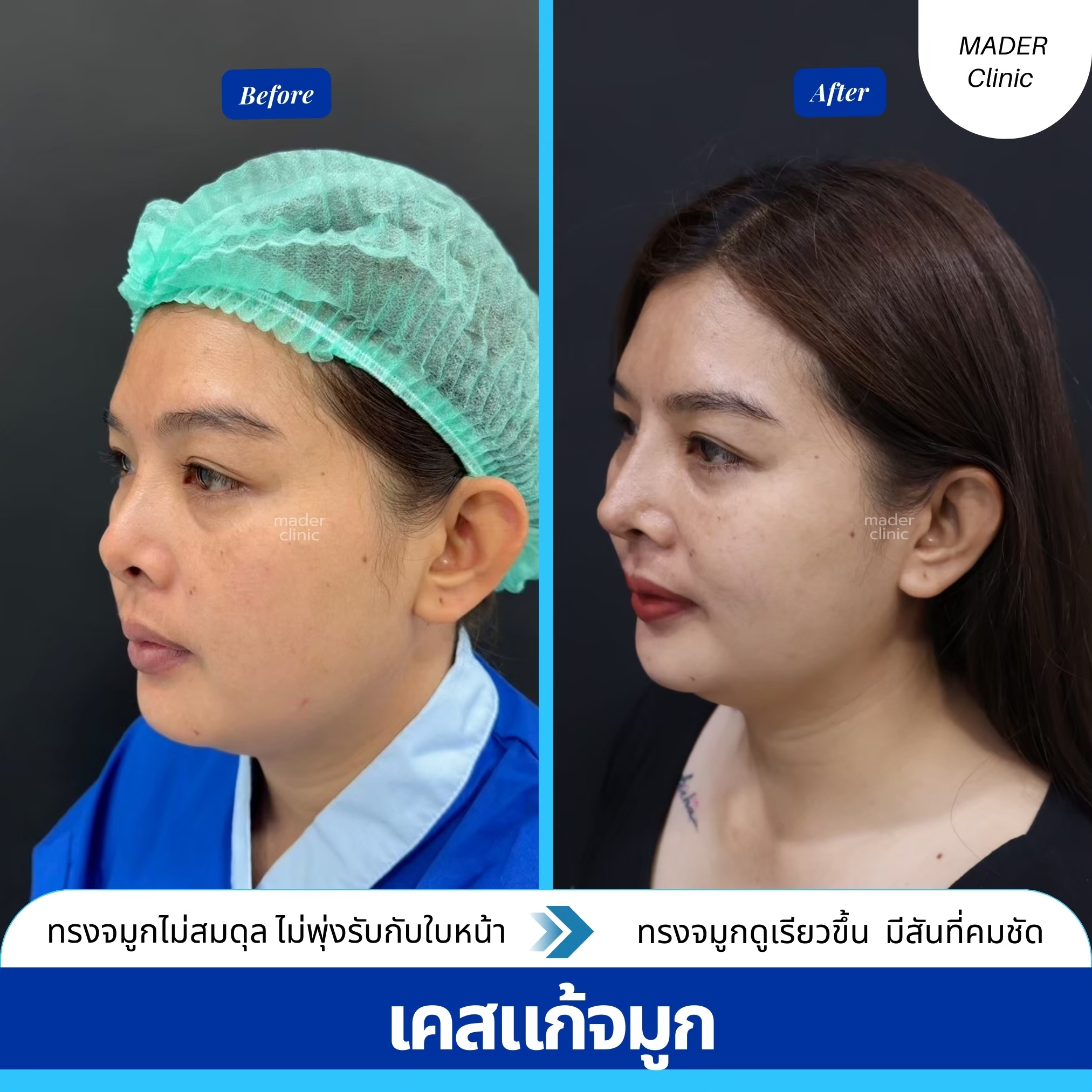 รีวิว MADER Clinic