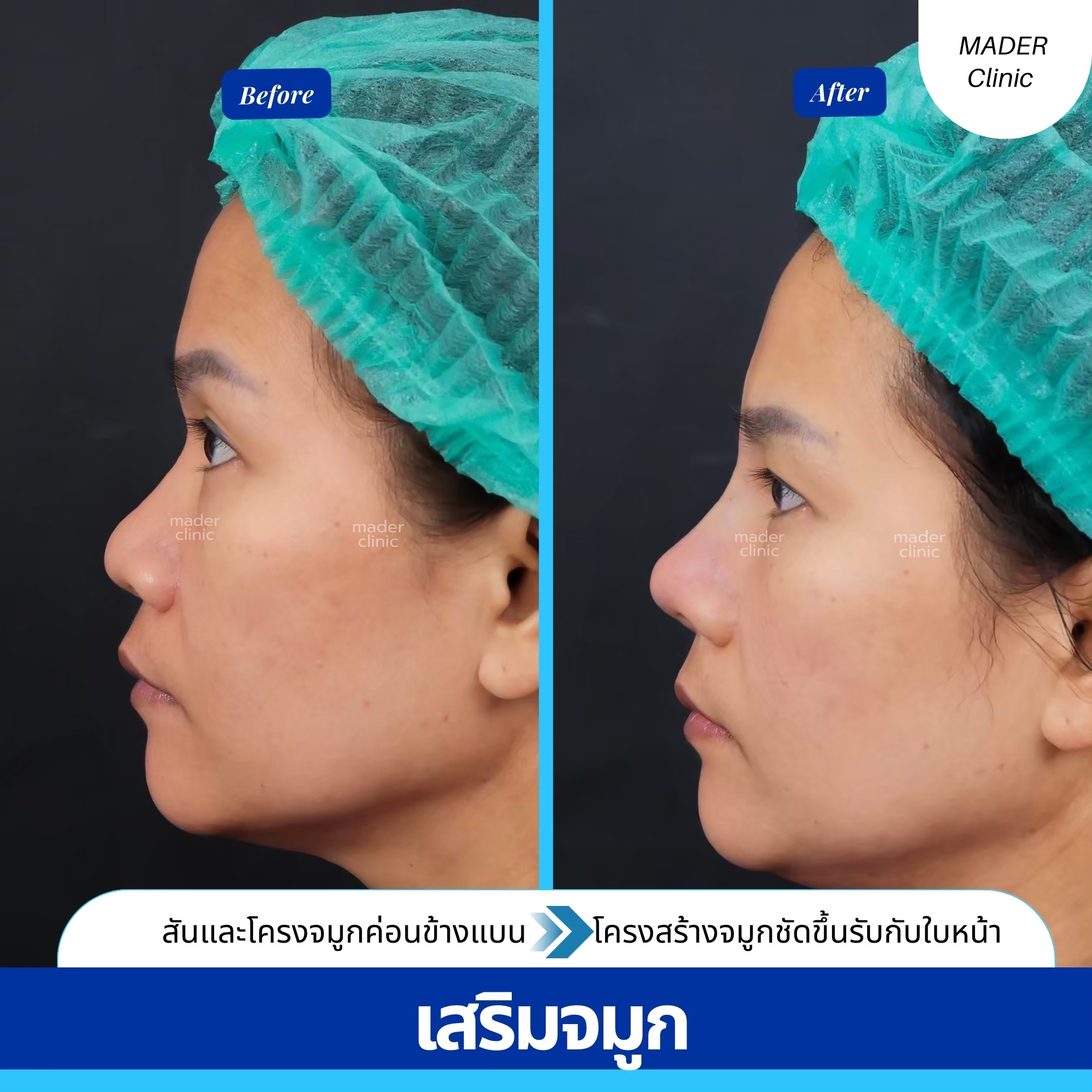 รีวิว MADER Clinic