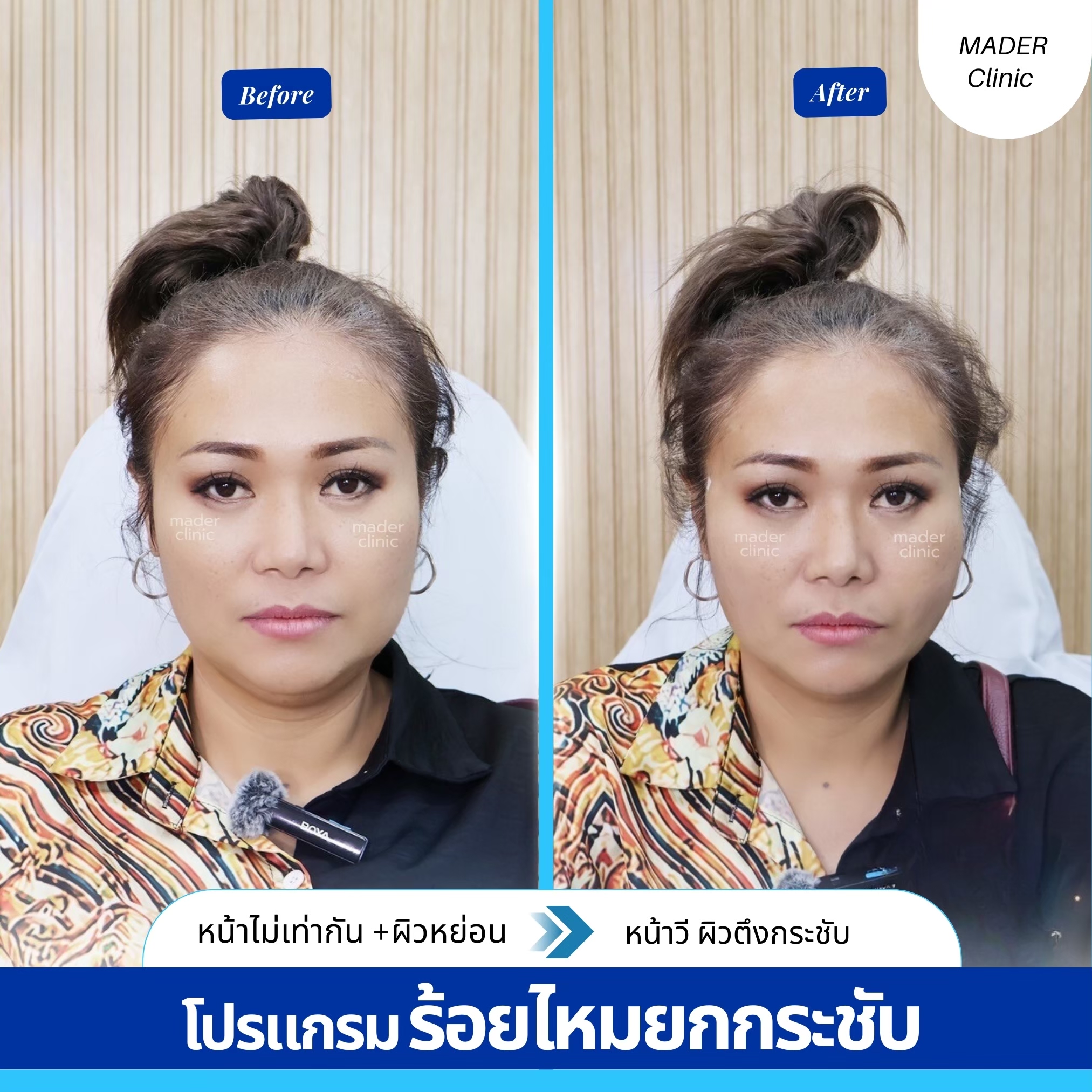 รีวิว MADER Clinic