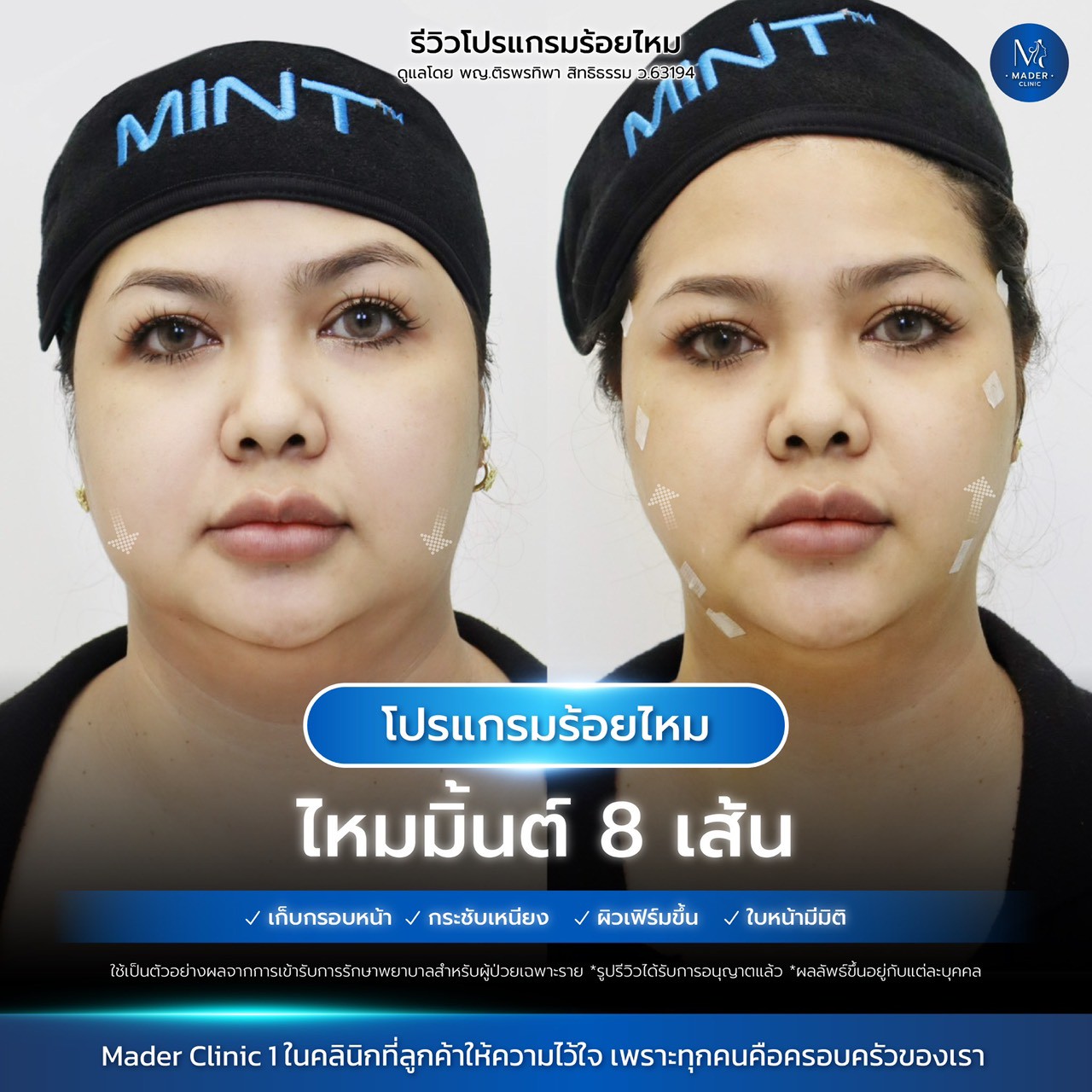 รีวิว MADER Clinic