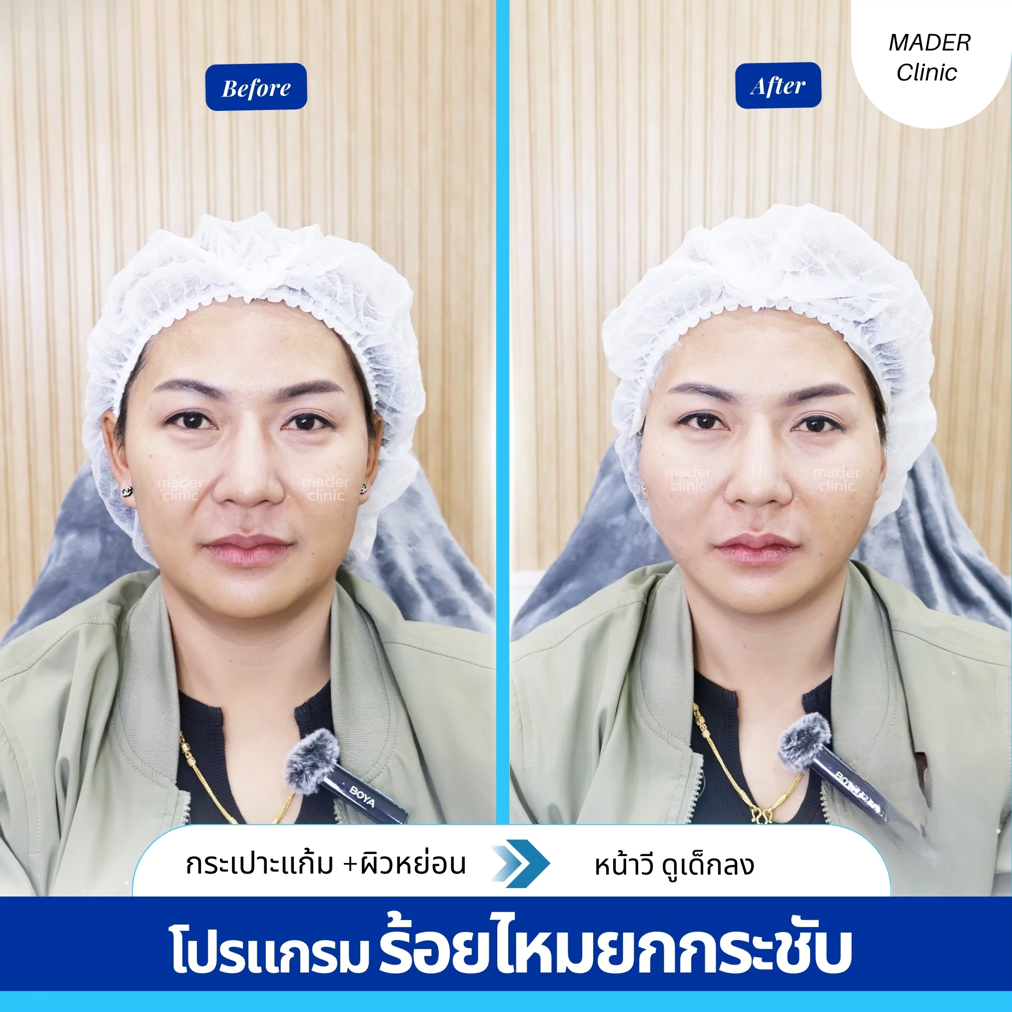 รีวิว MADER Clinic